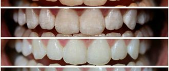отбеливающий гель для зубов global white