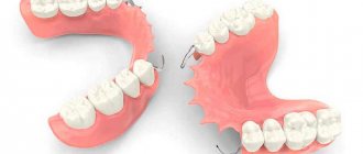 Differences between fixation on the upper and lower jaw