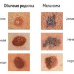 differences between melanoma and mole