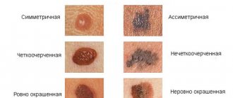 differences between melanoma and mole