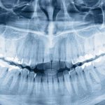 Panoramic photo of teeth - Smile Line Dentistry