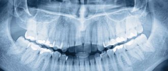 Panoramic photo of teeth - Smile Line Dentistry