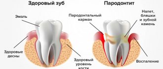 Пародонтит