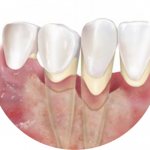 periodontal disease