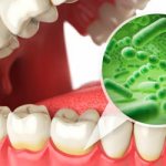 Pathogenic microorganisms contribute to aphthous stomatitis - Dentistry Line Smiles