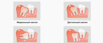 Патологии прорезывания зуба мудрости в картинках