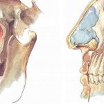 Perforation of the maxillary sinus