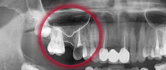 perforation of the maxillary sinus