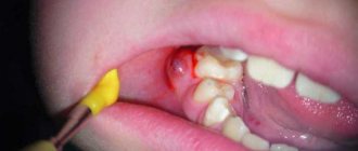 Periapical pathologies: how to treat?