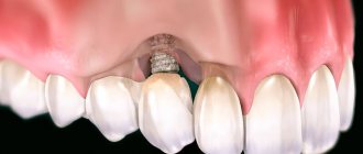 Peri-implantitis