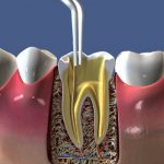 пломбирования корневых каналов