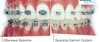 Почему брекеты Damon снимают быстрее, чем обычные