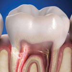 why do my teeth hurt after cold weather?