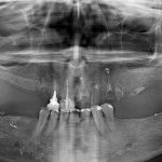 Why does bone tissue decrease in the absence of teeth? So, let&#39;s talk a little about the causes of bone loss. 