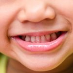 Why do babies get caries?