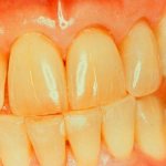 Why do teeth turn yellow?