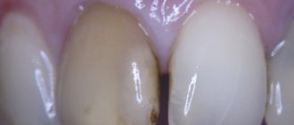 why did the tooth start to turn black?