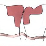 Preparation for tooth contact point restoration