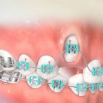 Показания и противопоказания к ортодонтическому вытяжению зуба