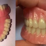 complete removable acrylic denture