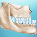 Последствия игнорирования лечения протрузии зубов