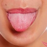 Superficial glossitis of the tongue