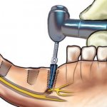 Nerve damage during implant placement