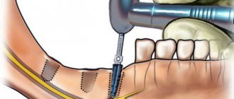 Nerve damage during implant placement