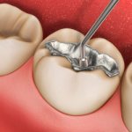 Появляется боль при надавливании на запломбированный зуб - Стоматология «Линия Улыбки»