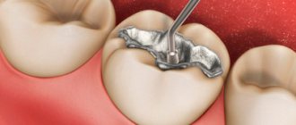 Появляется боль при надавливании на запломбированный зуб - Стоматология «Линия Улыбки»