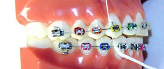 Преимущества зубных нитей «Суперфлосс»