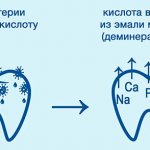 Причины кариеса