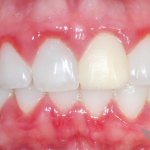 An example of gingivitis