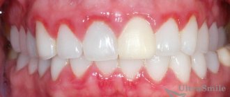 An example of gingivitis