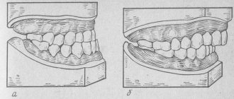 Progeny and prognathia