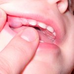 Teething of molars in children: symptoms