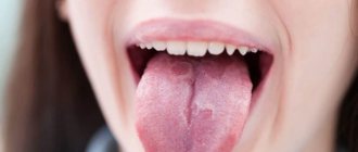 Tongue cancer