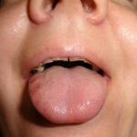 Sores on the sides of the tongue from teeth