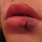 How long does it take for a split lip to heal?