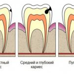 Development of periodontitis