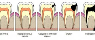 Development of periodontitis