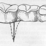 Recommendations after gum incision