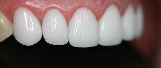 Restorative teeth whitening