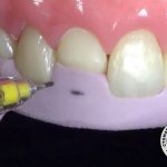 Teeth restoration with silicone key