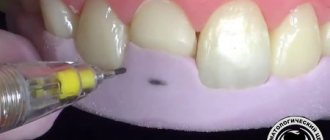 Teeth restoration with silicone key