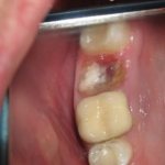 Результат неудачного домашнего лечения альвеолита после удаления зуба на фото