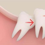 Wisdom tooth growth