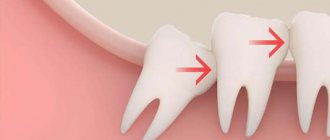 Wisdom tooth growth