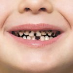 The most common dental diseases in childhood - Smile Line Dentistry