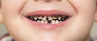 Самые распространенные стоматологические заболевания в детском возрасте - Стоматология «Линия Улыбки»